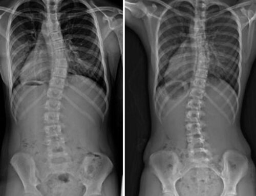 Natural Scoliosis Solution