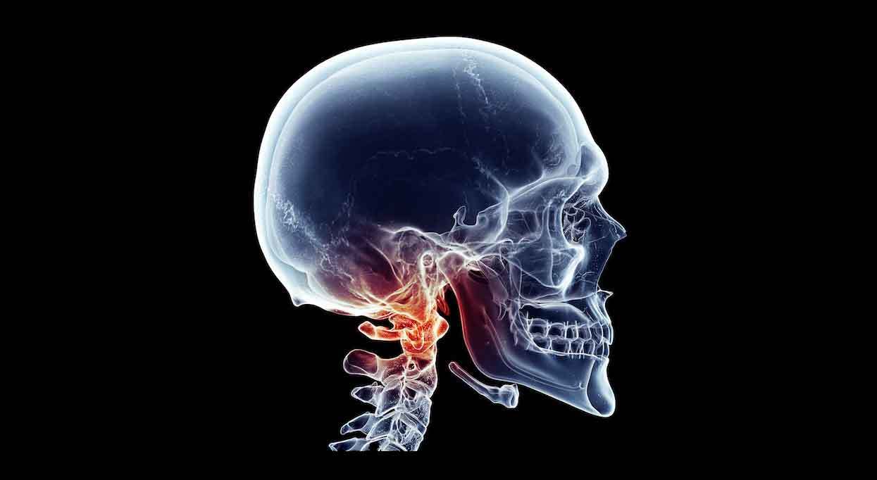 What does MRI/CBCT scan of the cervical spine show